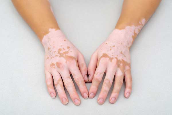 Services - Leukoderma