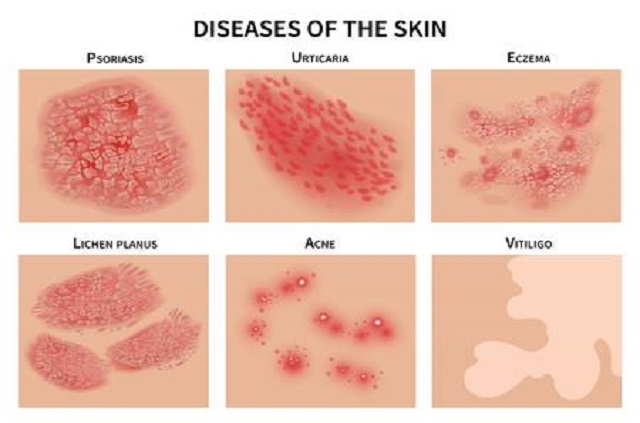 Services - Eczema and Psoriasis